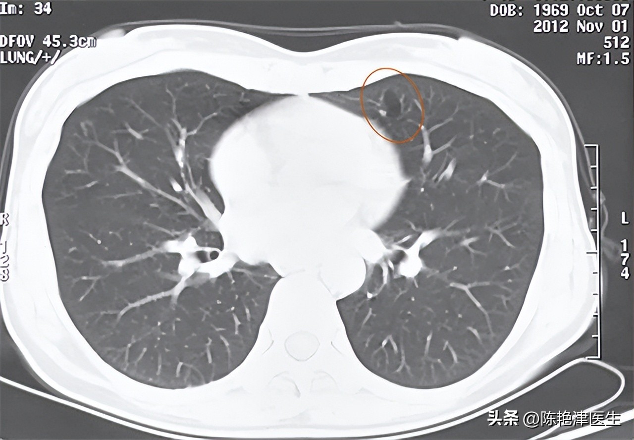 为什么医生不肯说肺大泡有多大,体检肺大疱是什么意思
