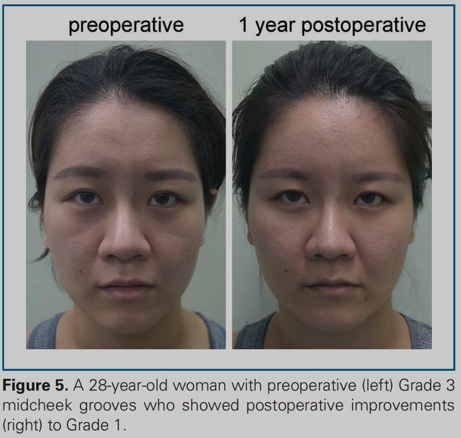 印第安纹解剖学,印第安纹分型对策