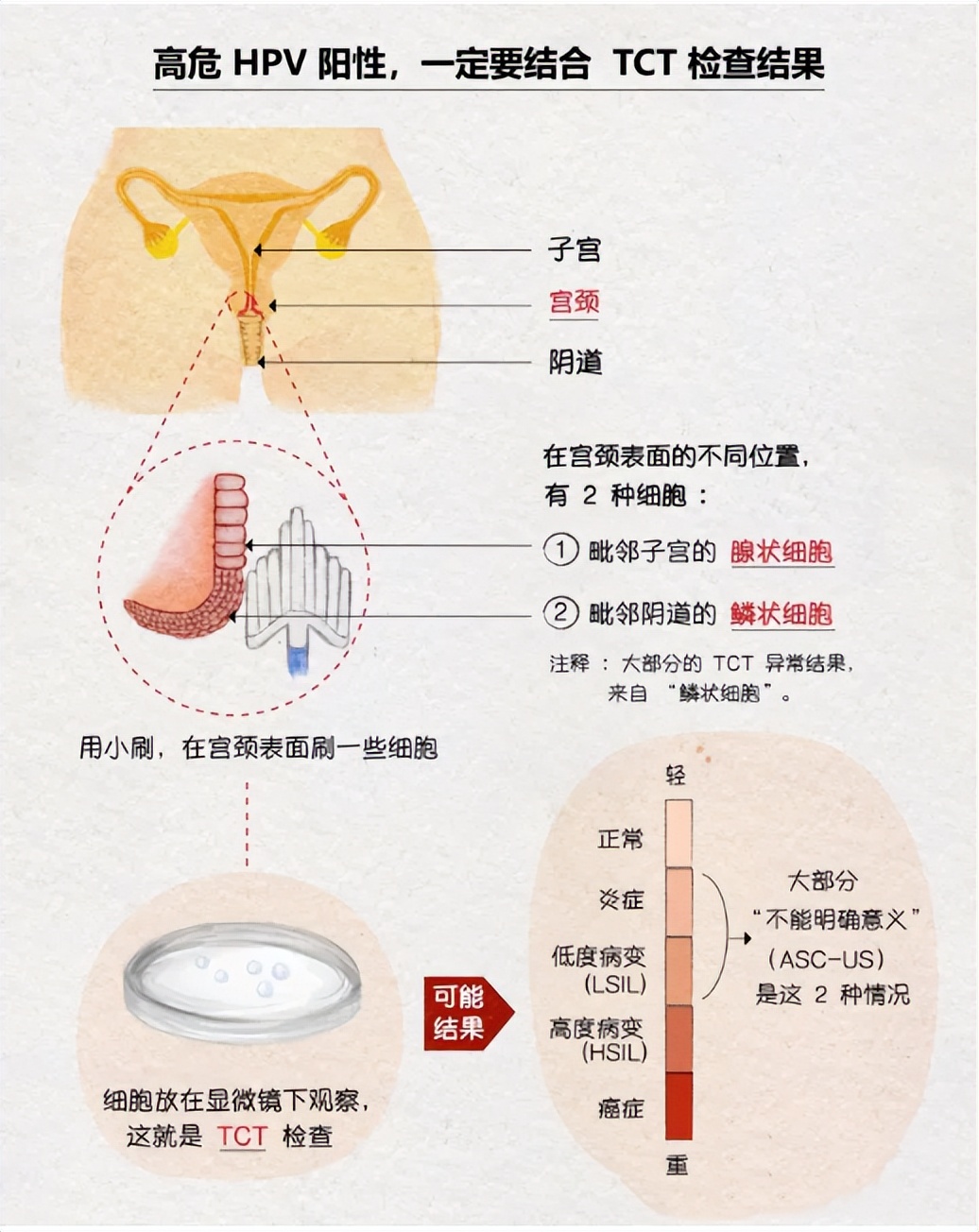 因为TA，33岁女士与宫颈癌擦肩而过！浙一妇科专家：会传染务必当心