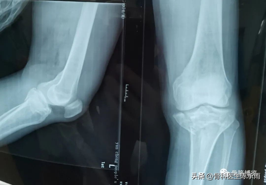 膝关节胫骨平台骨折,最近胫骨平台骨折视频