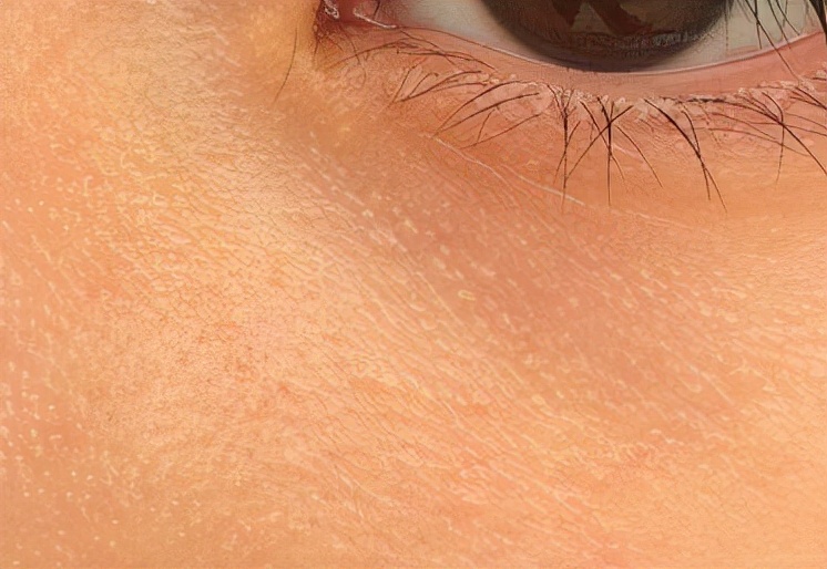 面对脂肪粒最好的办法,莫要让脂肪粒阻碍你魅力释放