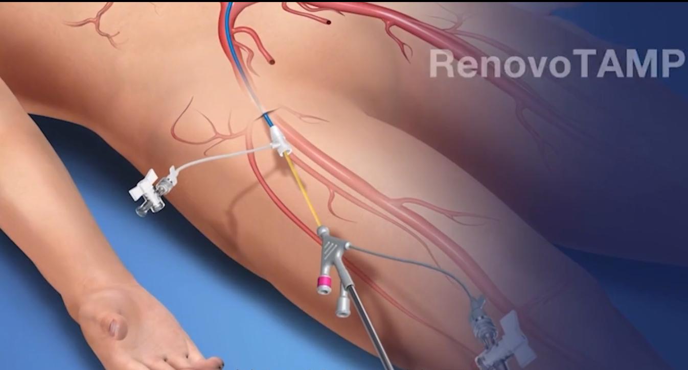介入手术治疗肠癌,24岁女孩肠癌手术