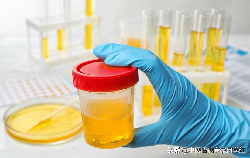 尿蛋白总降不下来原因到底在哪,尿蛋白迟迟降不下来是什么原因