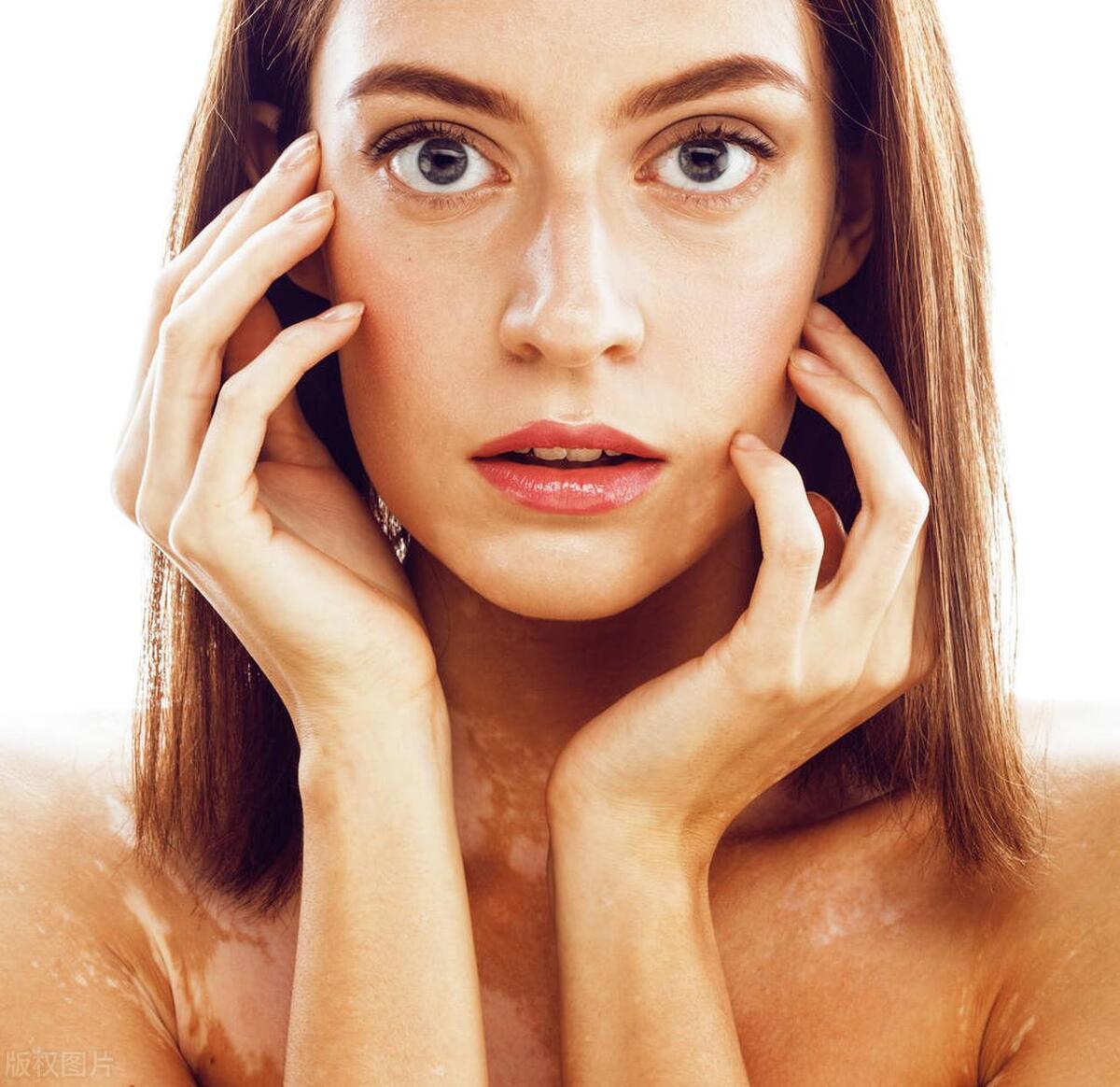 泛发性白癜风的症状有哪些特点,得了白癜风应该怎么治疗呢