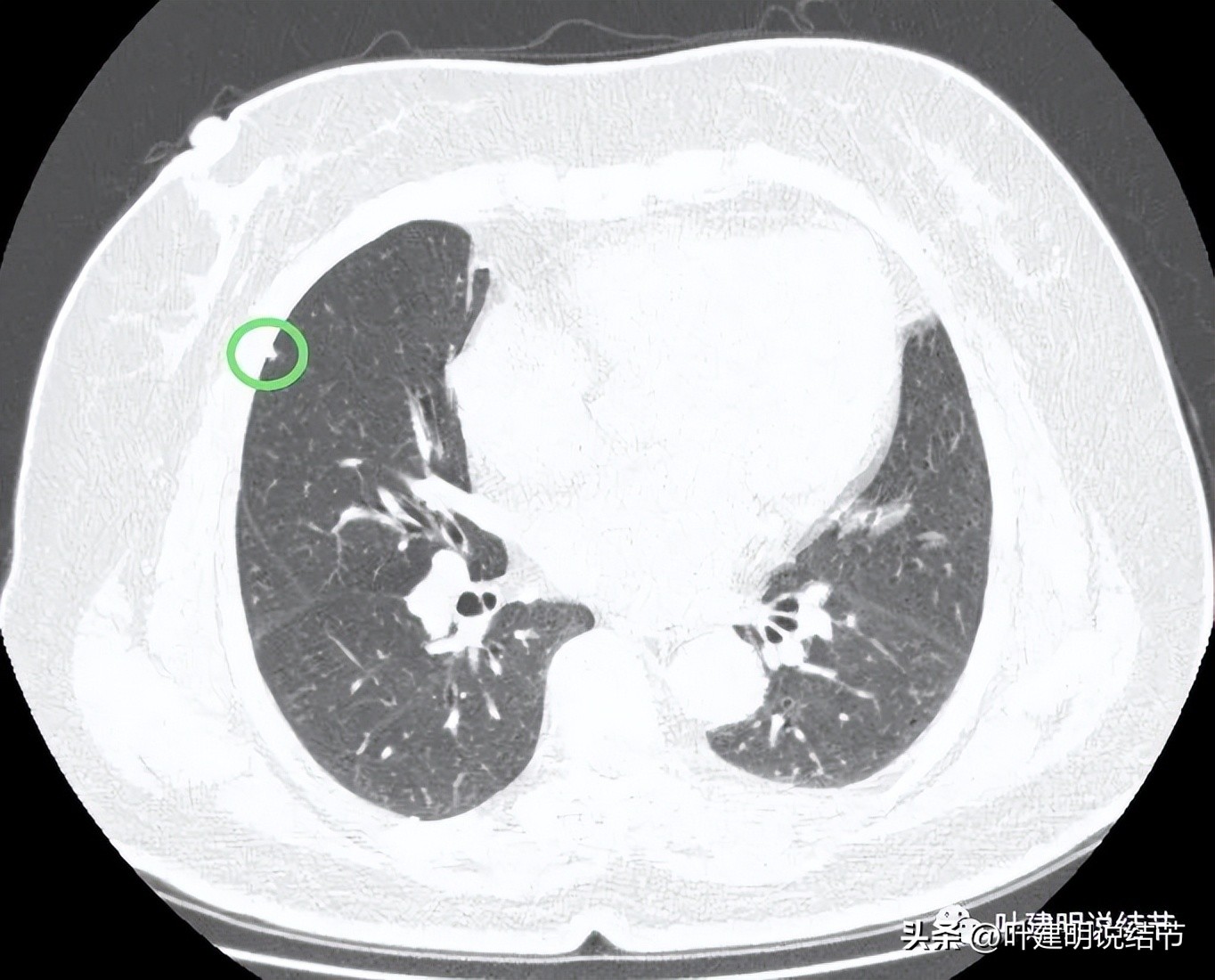 肺结节实性为什么建议抗炎治疗,肺上实性结节抗炎后变成空洞