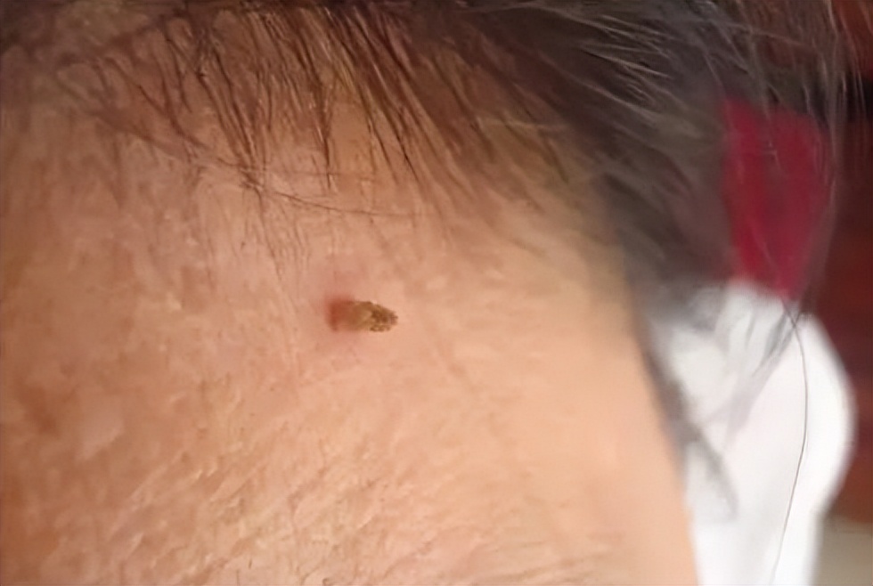 脖子上有包块是怎么回事,脖子上的丝状疣怎么去除