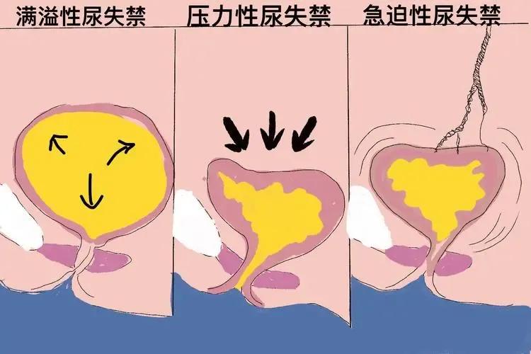 老年女性打喷嚏就漏尿,出门要穿纸尿裤,如何解决