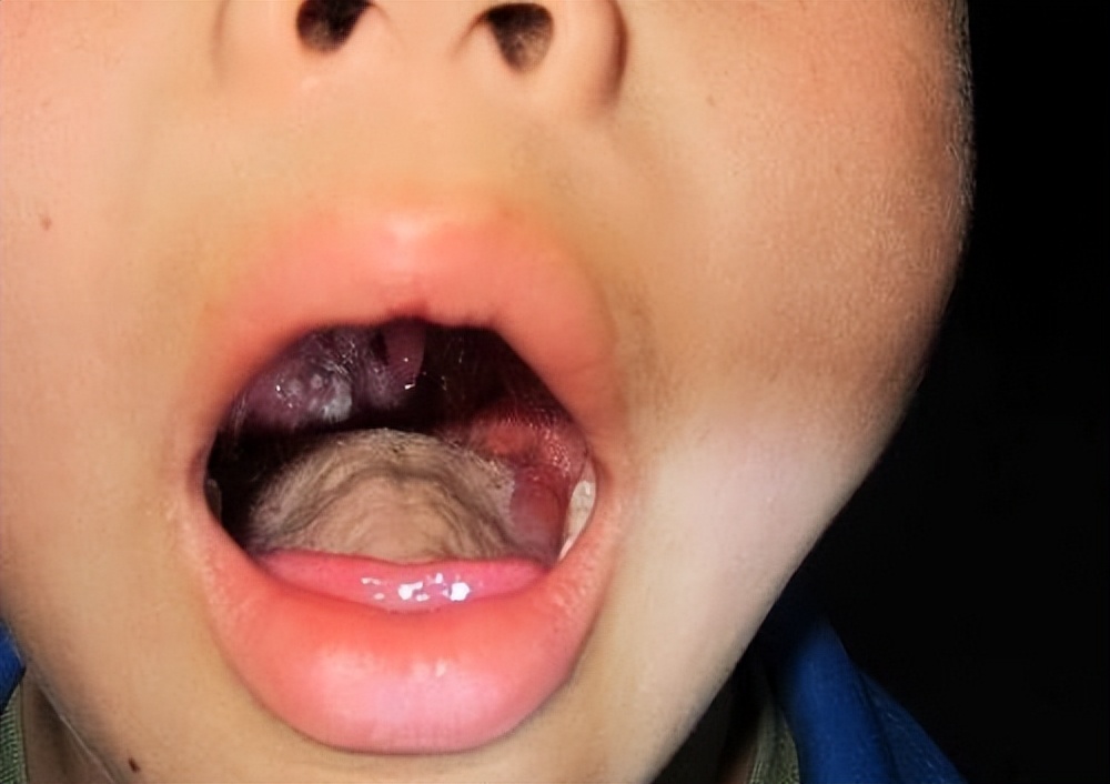 治疗化脓性扁桃体炎的首选中药,儿童化脓性扁桃体炎中医怎么治疗