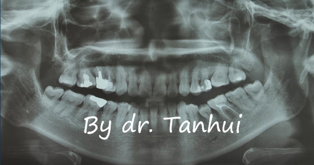 地包天能做手术矫正吗,儿童地包天矫正几岁做最好