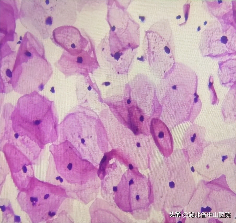 宫颈癌筛查tct异常hpv正常没事吧,确诊宫颈癌的tct结果是什么