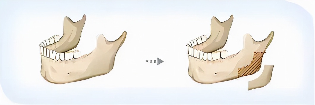 下颌角比较突出怎么改善,下颌问题是什么