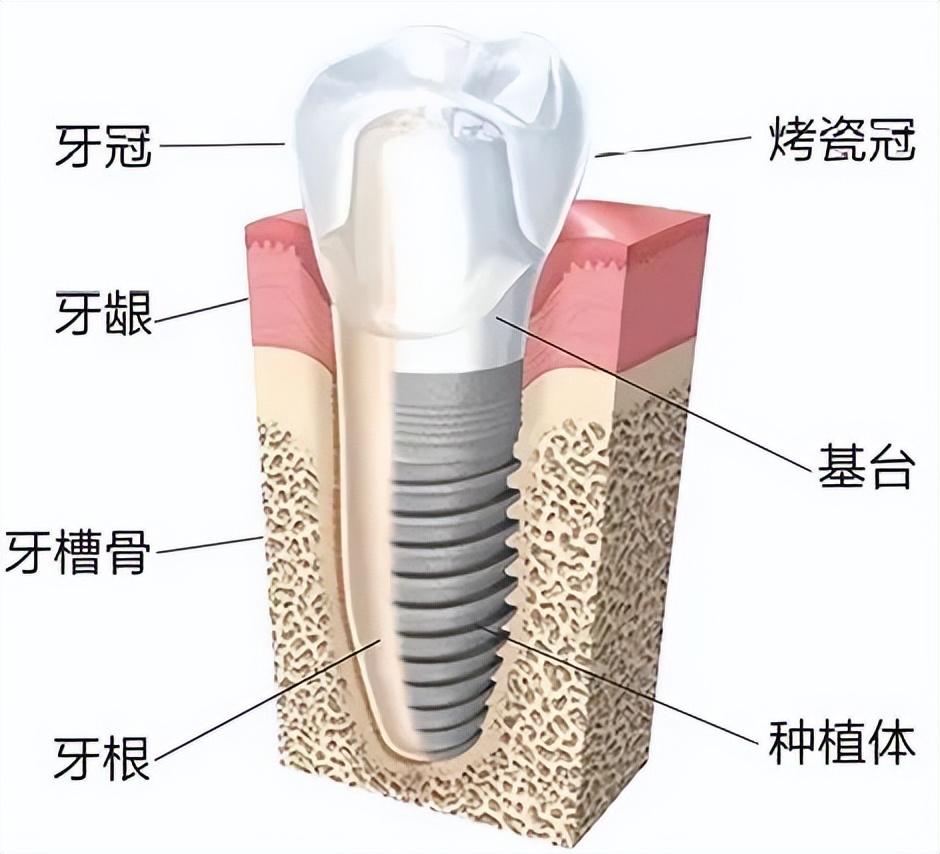 北京种植牙怎么操作,北京种植牙需要哪些步骤