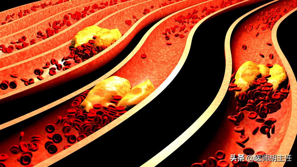 年轻人斑块是否能逆转,55岁大叔斑块消失