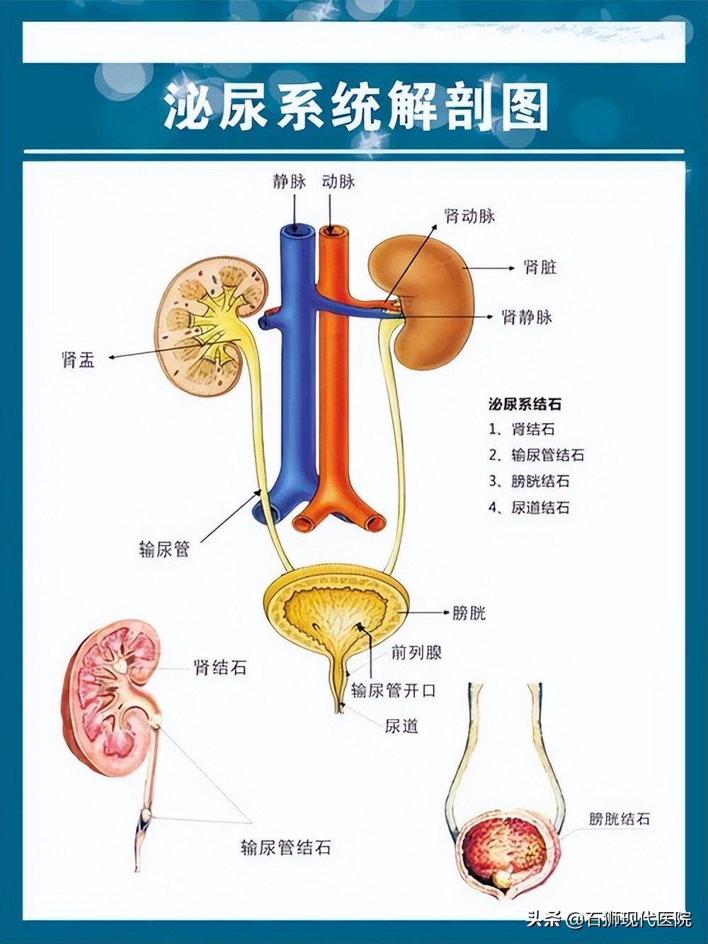 泌尿系结石怎么预防最好,各种泌尿结石的预防措施