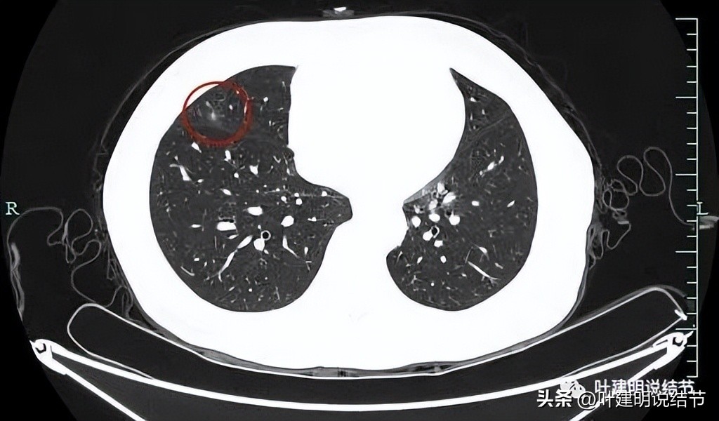 辽宁省肺结节手术哪家医院好,辽宁肺结节手术医院