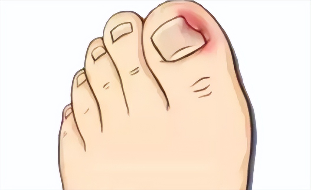 一走路脚趾甲痛,甲沟炎拔完脚趾甲很疼怎么办