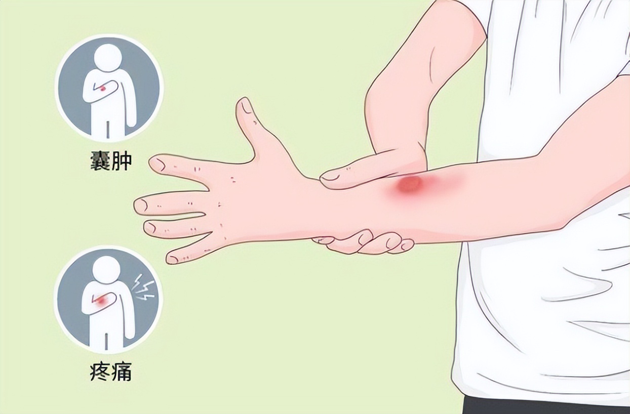 医生说有个小囊肿要注意些什么,医生治囊肿