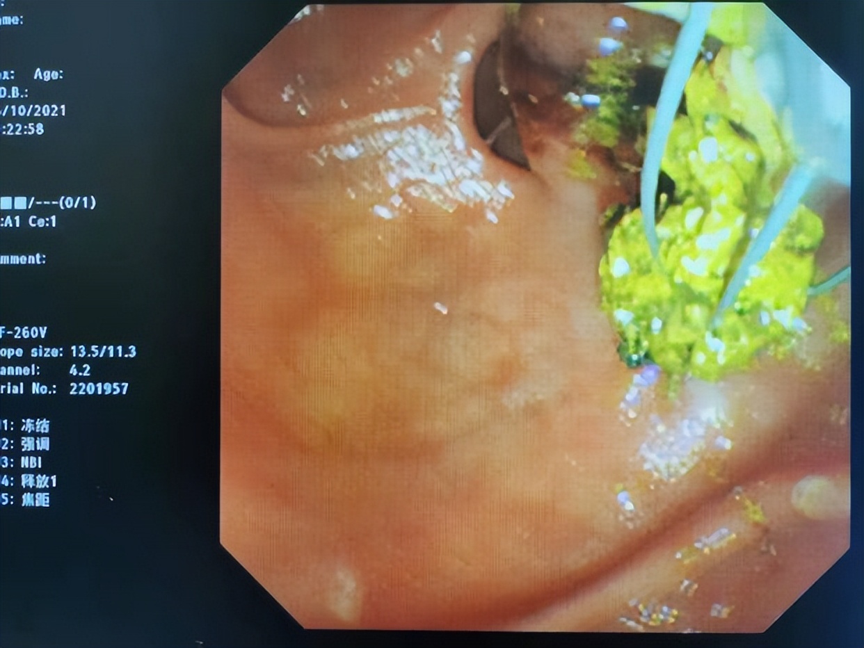 肚子痛一定是肠胃有问题了吗,如何分清肚子疼和胃痛