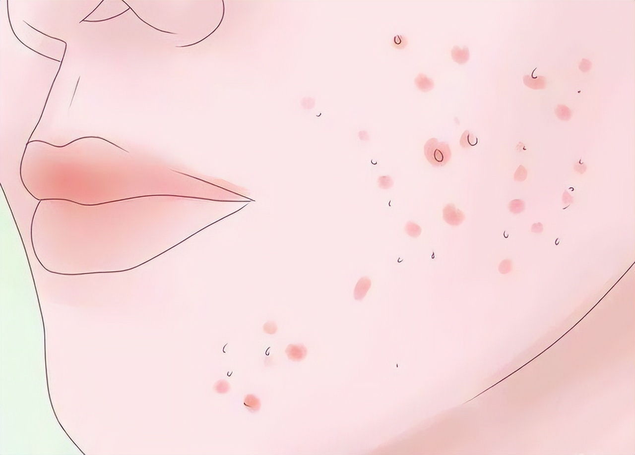 每个人身上都有疣,身上四种疣