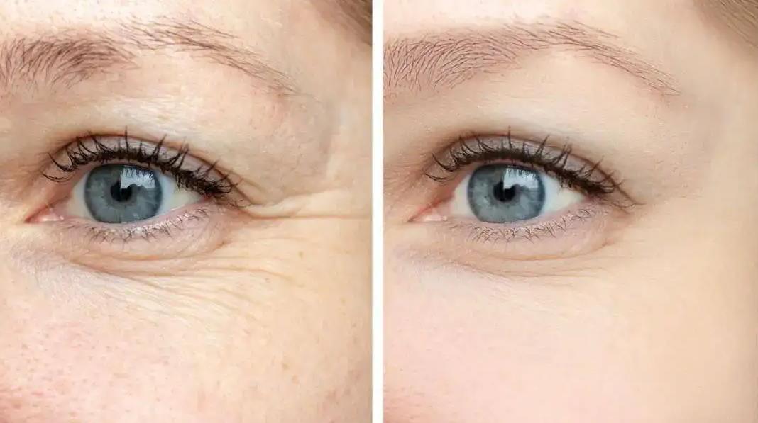 脸部皱纹分很多种，第一显老的是它？来看看如何“对症下药”