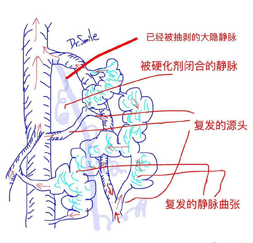 静脉曲张是怎么引起的能根治吗,静脉曲张可怕吗如何正确治疗
