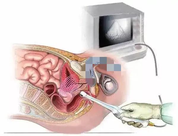 慢性非细菌性前列腺炎影响生育吗,慢性非细菌性前列腺炎小便有泡沫