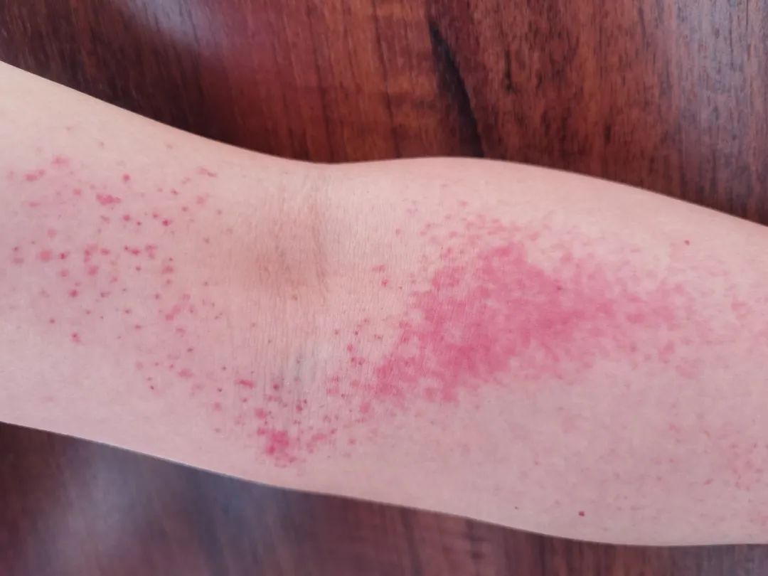 胳膊连着腋下有红色疹子,胳膊肘突然起了好多小红点