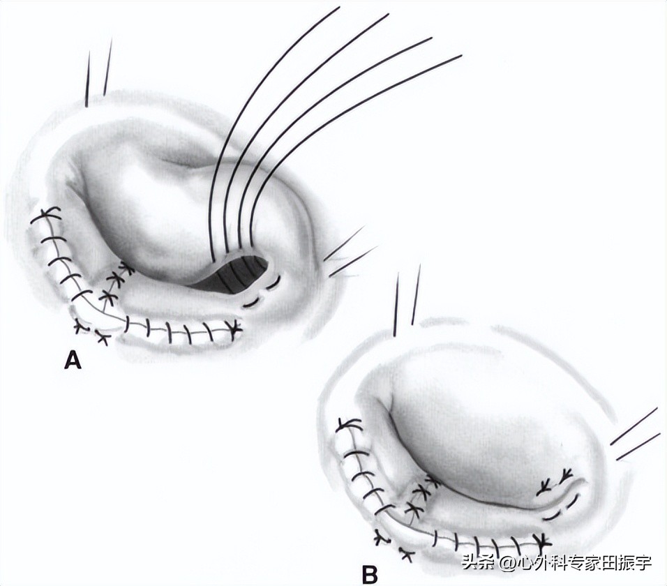二尖瓣成形术要多少钱,二尖瓣成形术后抗凝多久
