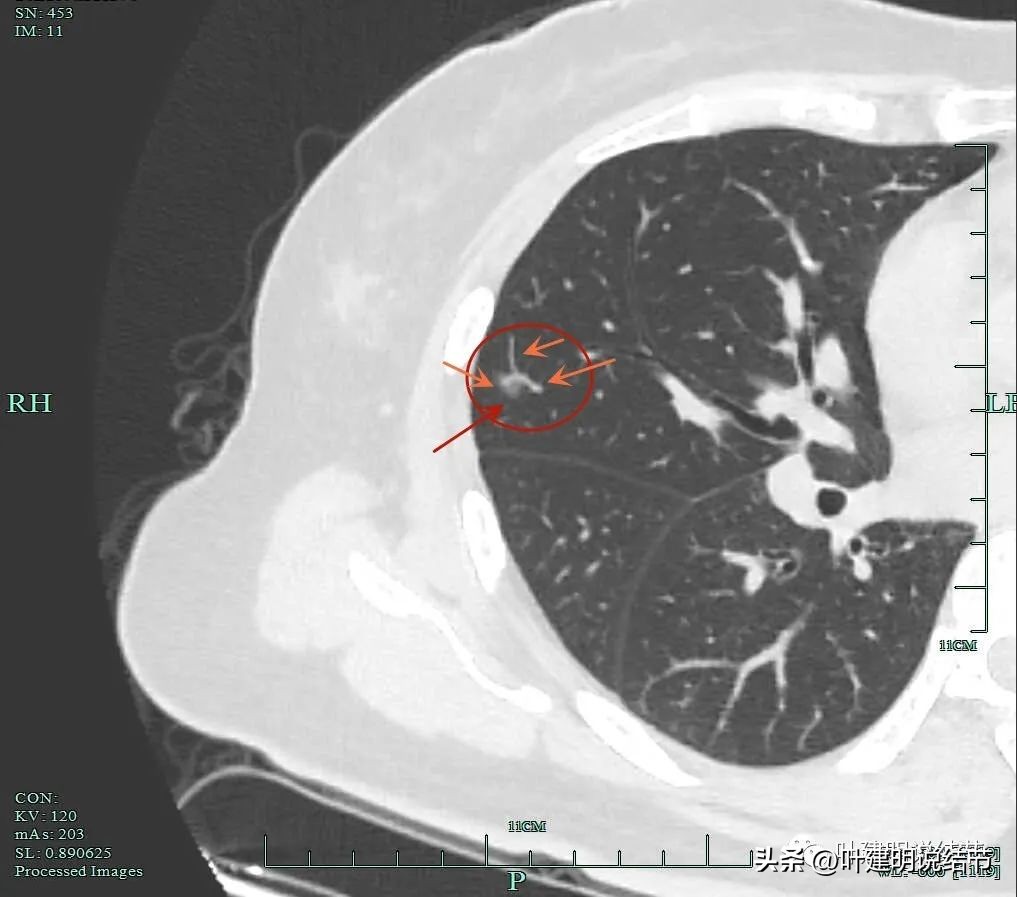 肺癌右中上叶全切,右肺上叶小结节查出是癌怎么办