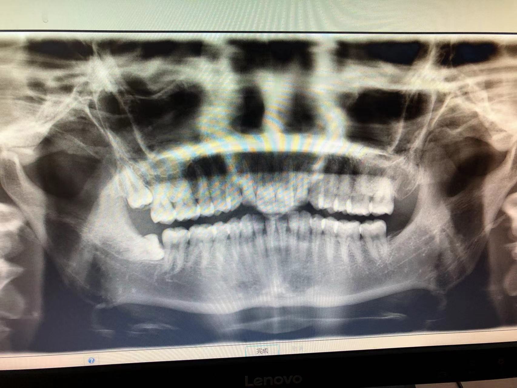 北医三院拔牙多少钱,北医三院拔牙能当天拔么