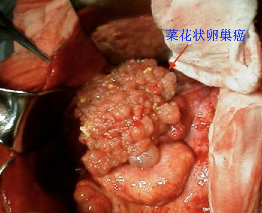 卵巢囊肿超声穿刺手术怎么做的,黄体囊肿与卵巢囊肿的超声区别