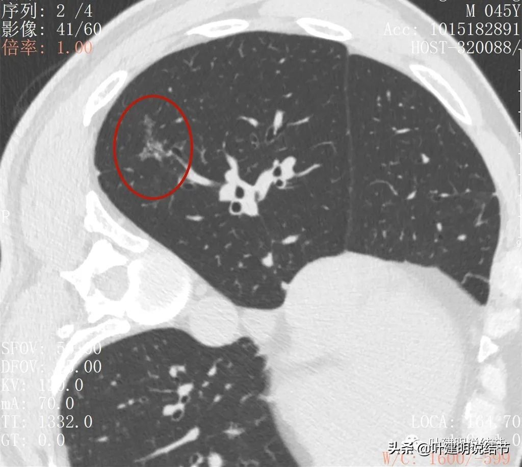 肺蜂窝状改变是肺癌吗,肺部陈旧灶与肿瘤怎么确诊