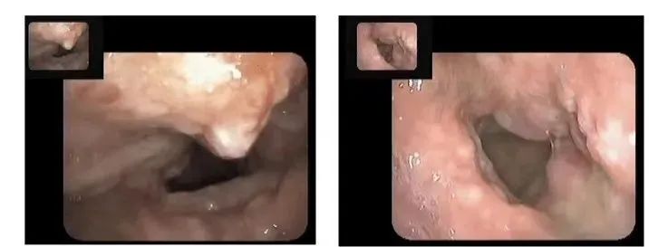 一觉醒来发现嗓子哑了,一觉醒来喉咙都变哑了一直不见好