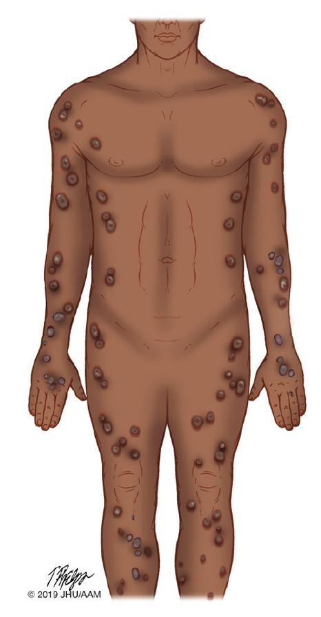 结节性痒疹病理检查,结节性痒疹可以用生物制剂治疗吗