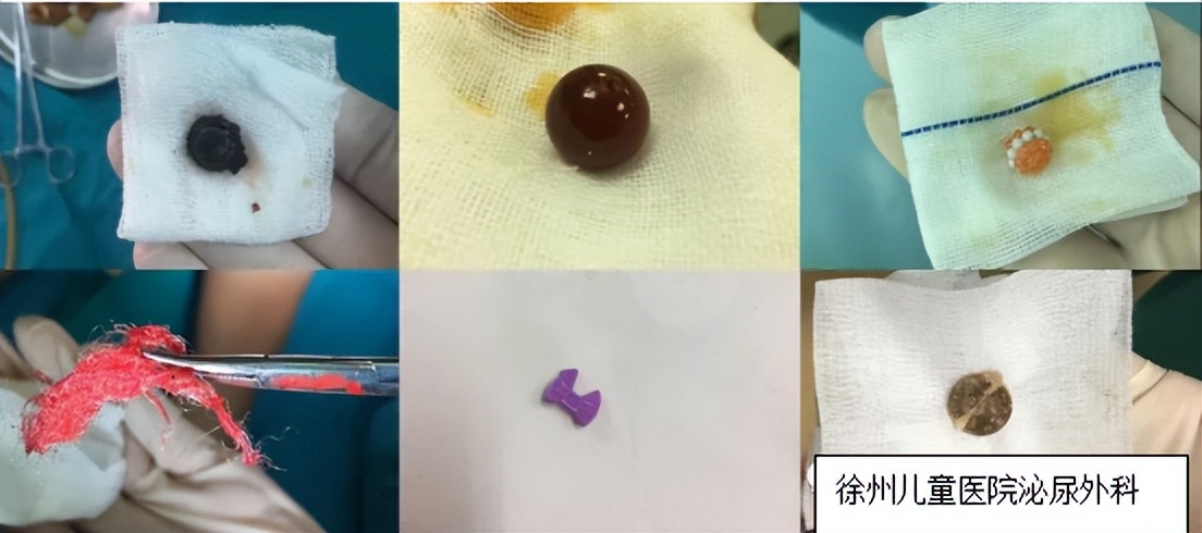 泌尿生殖系统异物怎么办？