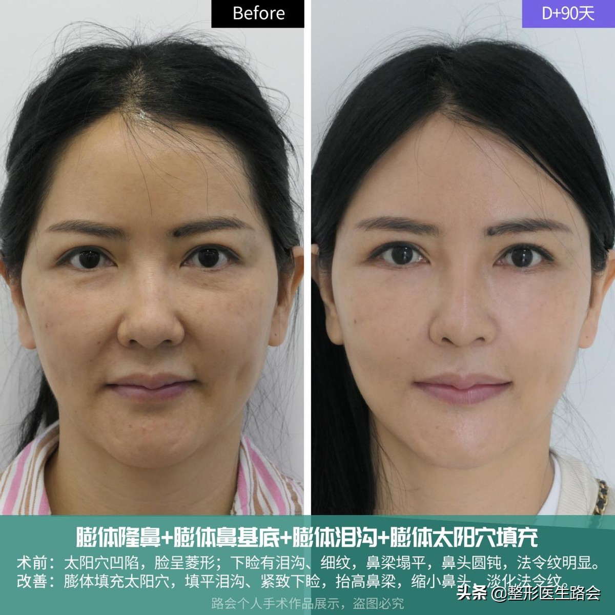 玻尿酸全脸填充年轻化,全脸玻尿酸填充真的会好看吗