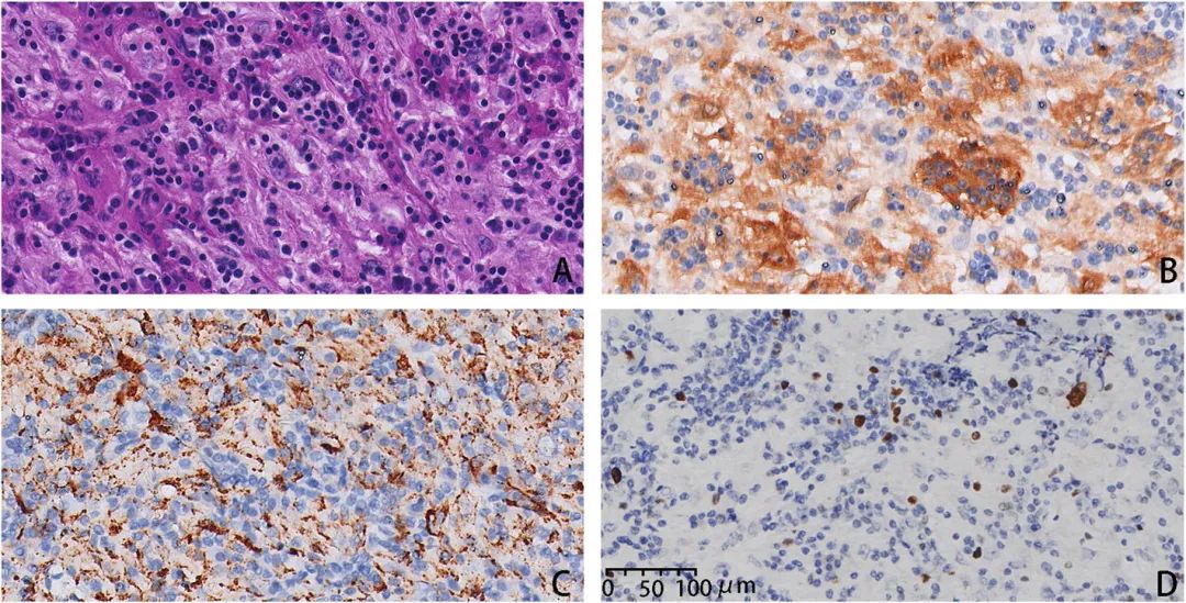 星闻丨领星携手中山一院金华伟教授团队探索中枢神经系统罗道病