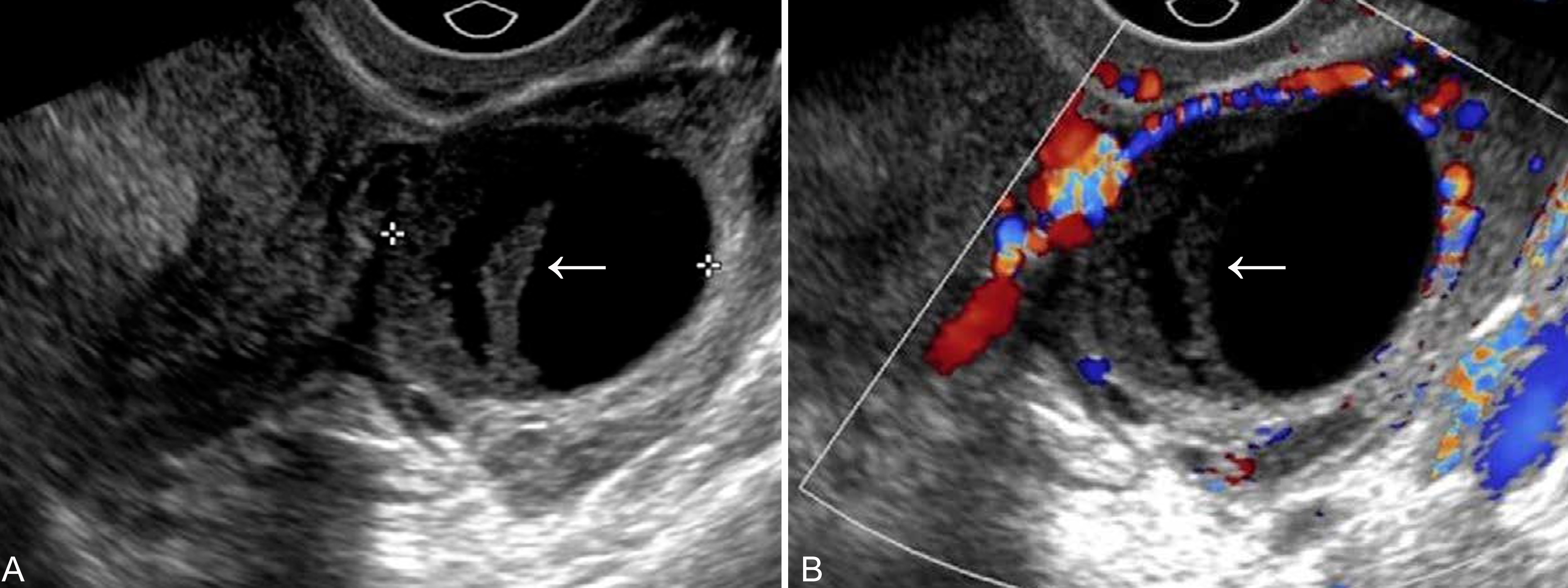 怀孕时的黄体囊肿结节是什么,怀孕一个多月有黄体囊肿30x28mm