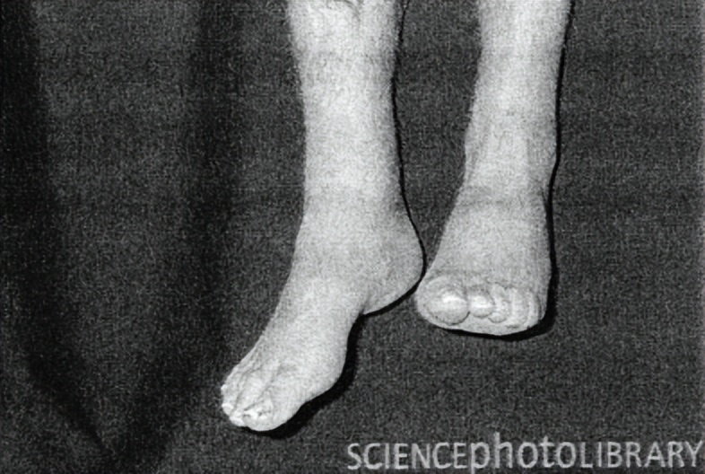 讯丰通偏瘫康复仪,讯丰通助行康复成功案例