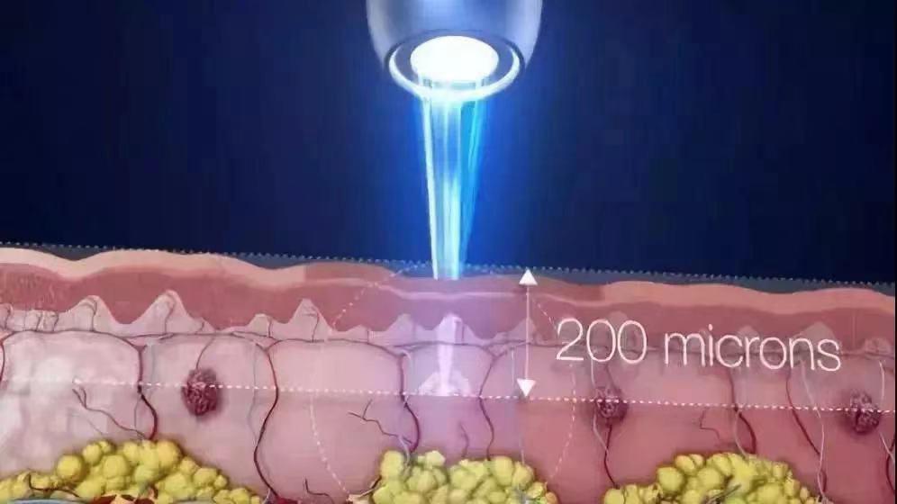 有效去黑眼圈和泪沟方法,黑眼圈泪沟抗衰老