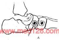 扁平足发病机制,扁平足诊断标准示意图