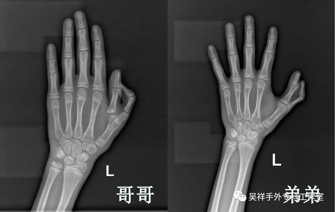罕见同卵不同性别的双胞胎,罕见四胞胎长得一模一样