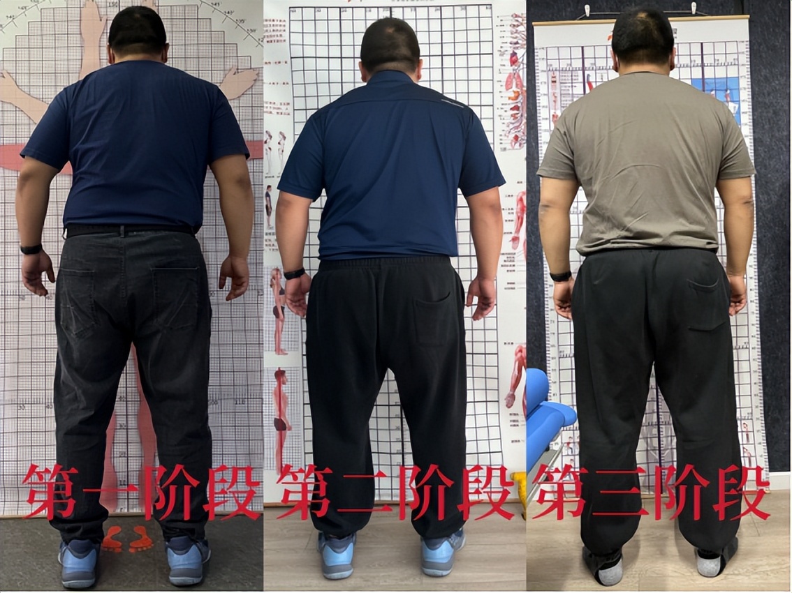 脊柱侧弯个案,冉冉高位截瘫