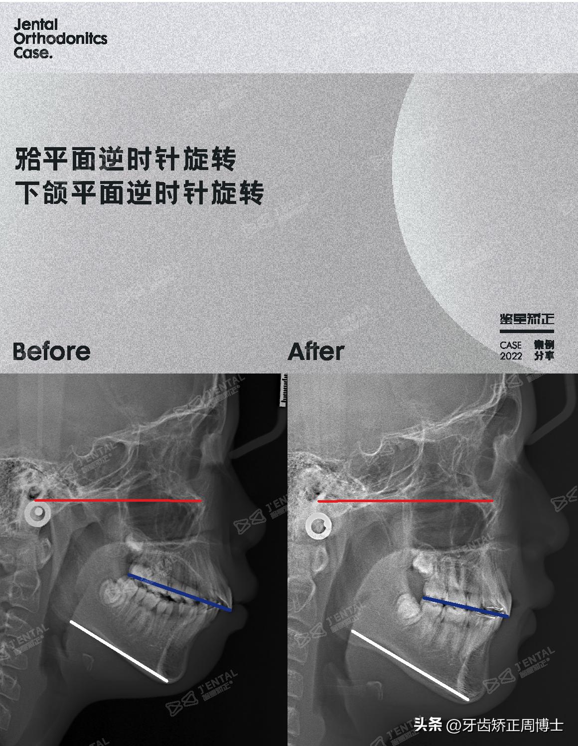 mrc戴上后不能闭上嘴怎么办,mrc矫正能用到几岁