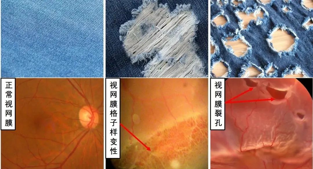 高度近视眼底黄斑病好治吗,高度近视检查眼底就行了吗