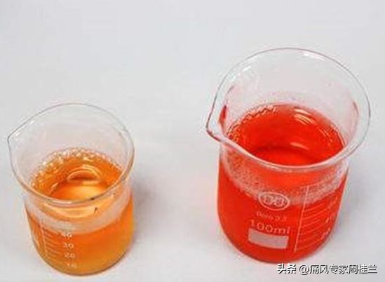 尿酸高的七个征兆官方,尿酸高的症状征兆