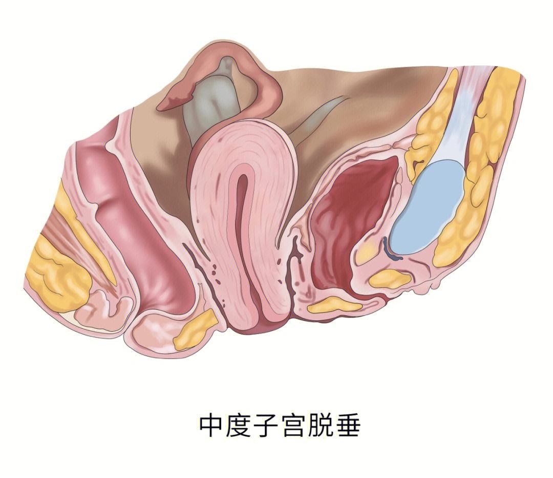 *生活性**时，女性*处私**总发出“噗噗”的放屁声？多和这4个原因有关