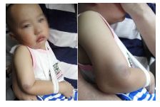 肱骨骨折取钢板怎样恢复,肱骨近端骨折切开复位内固定术