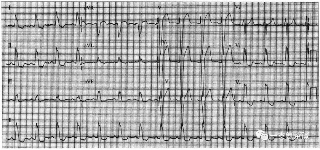 心电图三步十招,心电图九九八十一难口诀