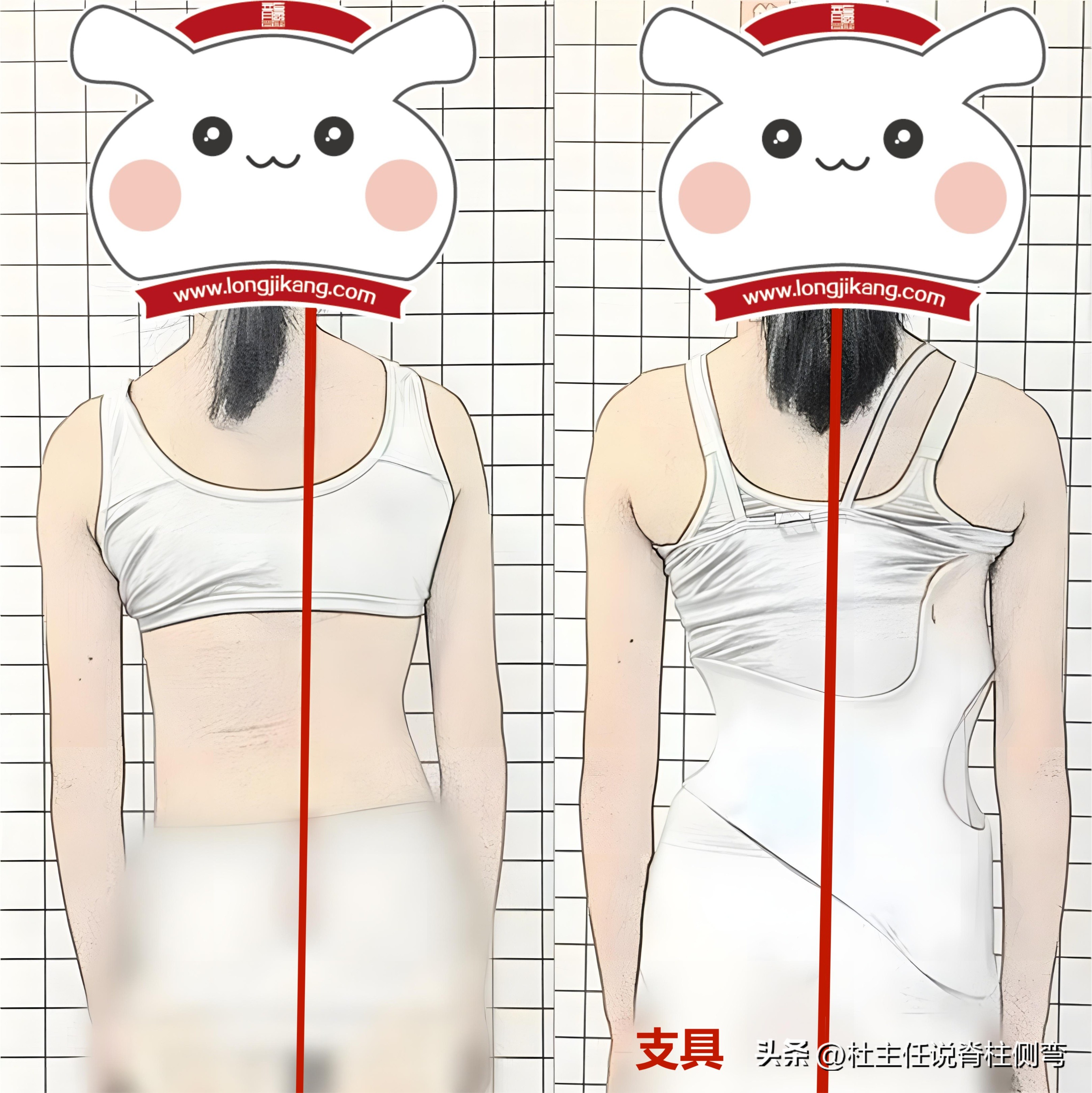 S型脊柱侧弯，一定要戴长支具矫形吗？此文告知您